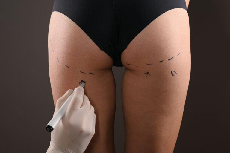 Surgeon marking patient’s thighs and buttocks for cosmetic enhancement procedure like BBL or butt implant surgery.
