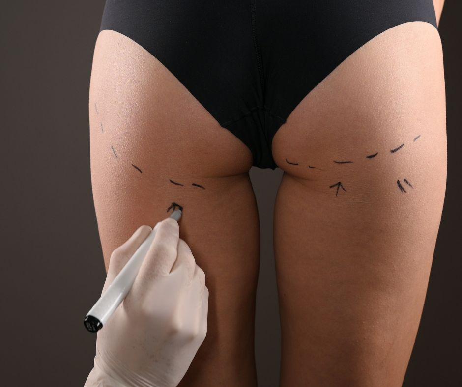 What Are the Different Types of Surgeries for My Butt? featured image