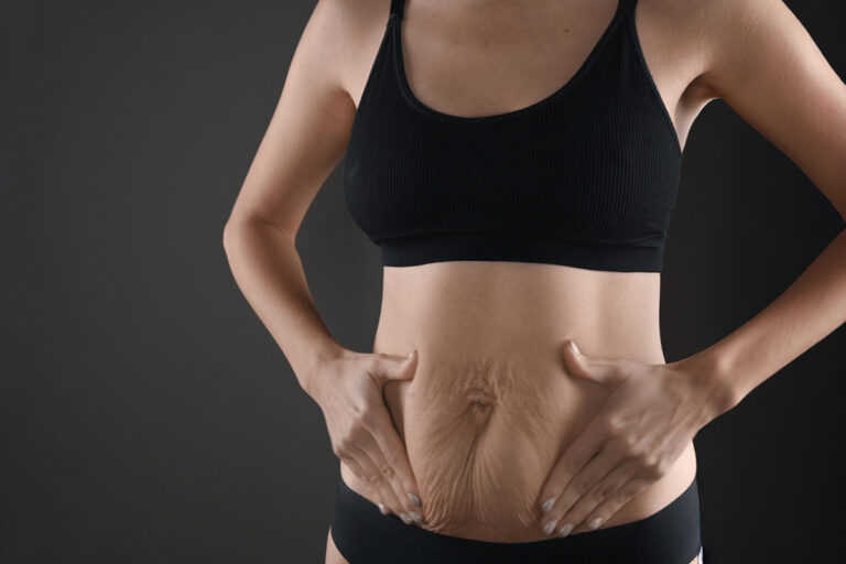 Woman in black activewear holding loose abdominal skin, demonstrating typical pre-surgery appearance before tummy tuck.