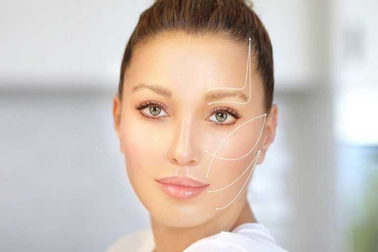 Woman with facial mapping lines indicating areas for facelift surgery to reduce wrinkles and restore youthful contours.