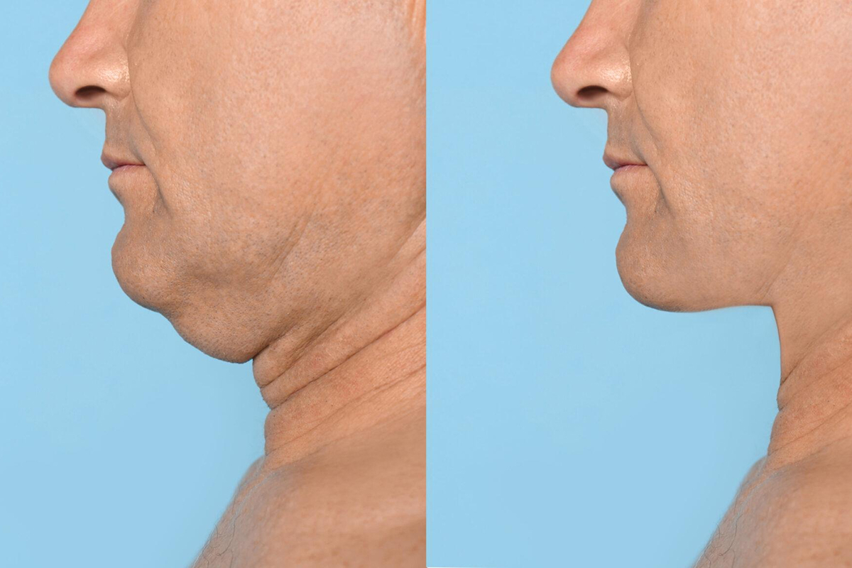 Side-by-side comparison of a man’s chin and neck before and after Kybella treatment for double chin reduction