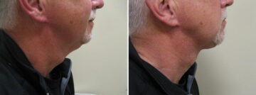 Before and after Neck Lift by Dr. David W. Allison, Patient 1447