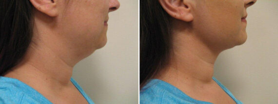 Before and after Neck Lift by Dr. David W. Allison, Patient 1451