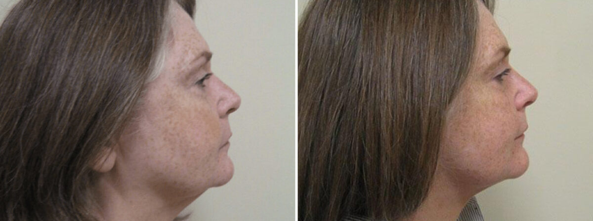 Before and after Face and Neck by Dr. David W. Allison, Patient 1455