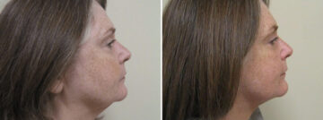 Before and after Face and Neck by Dr. David W. Allison, Patient 1455
