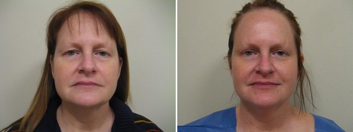 Before and after Face and Neck by Dr. David W. Allison, Patient 1459