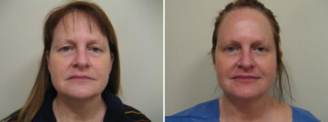 Before and after Face and Neck by Dr. David W. Allison, Patient 1459