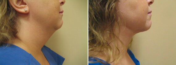 Before and after Face and Neck by Dr. David W. Allison, Patient 1463