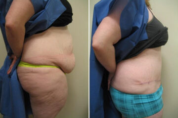 Before and after Abdominoplasty by Dr. David W. Allison, Patient 1467