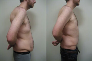 Before and after Abdominoplasty by Dr. David W. Allison, Patient 1471