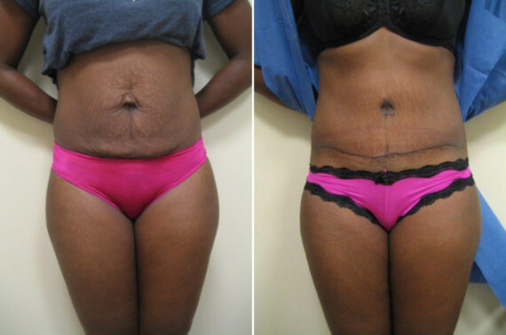 Before and after Abdominoplasty by Dr. David W. Allison, Patient 1475
