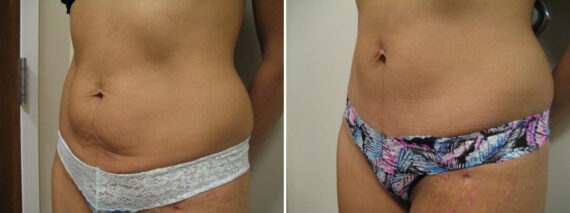 Before and after Mini-Abdominoplasty by Dr. David W. Allison, Patient 1479