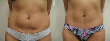 Before and after Mini-Abdominoplasty by Dr. David W. Allison, Patient 1479