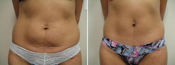Before and after Mini-Abdominoplasty by Dr. David W. Allison, Patient 1479