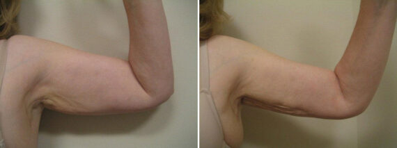 Before and after Arm Liposuction by Dr. David W. Allison, Patient 1486
