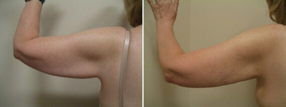Before and after Arm Liposuction by Dr. David W. Allison, Patient 1486