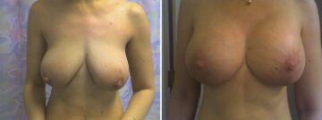 Before and after Breast Augmentation by Dr. David W. Allison, Patient 1493