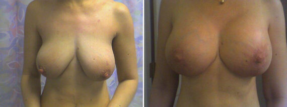 Before and after Breast Augmentation by Dr. David W. Allison, Patient 1493