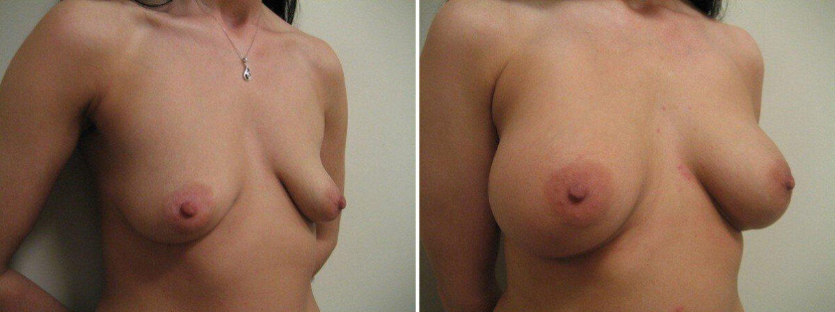 Before and after Breast Augmentation by Dr. David W. Allison, Patient 1497