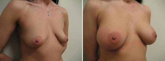 Before and after Breast Augmentation by Dr. David W. Allison, Patient 1497