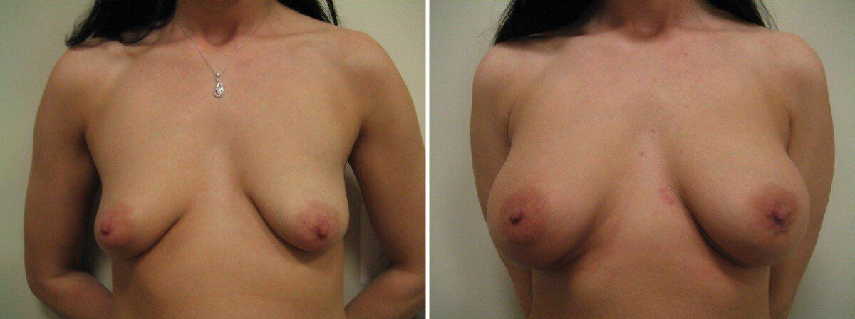 Before and after Breast Augmentation by Dr. David W. Allison, Patient 1497