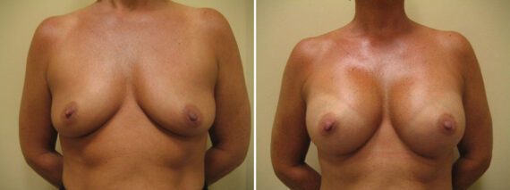 Before and after Breast Augmentation by Dr. David W. Allison, Patient 1504