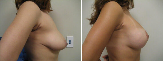 Before and after Breast Augmentation by Dr. David W. Allison, Patient 1508