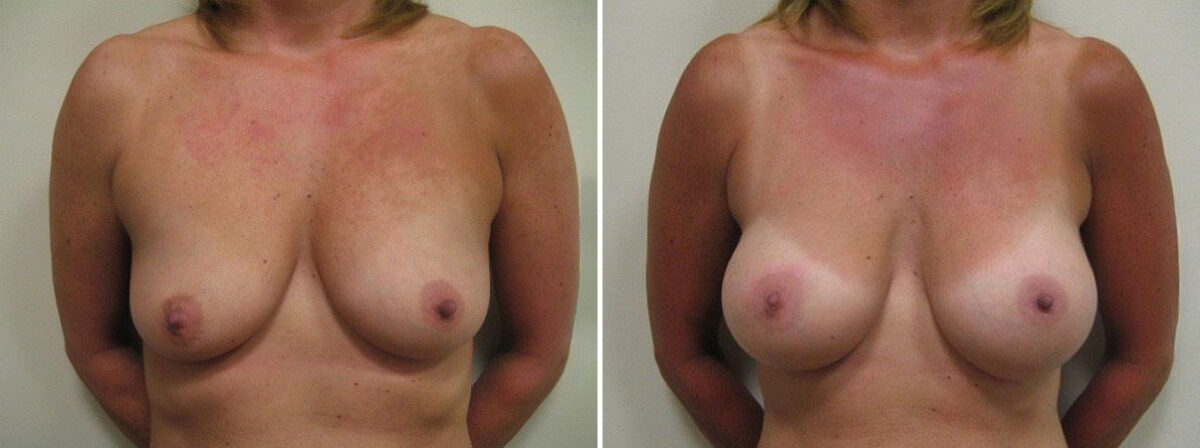 Before and after Breast Augmentation by Dr. David W. Allison, Patient 1515