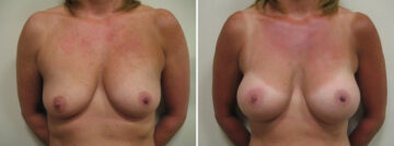 Before and after Breast Augmentation by Dr. David W. Allison, Patient 1515