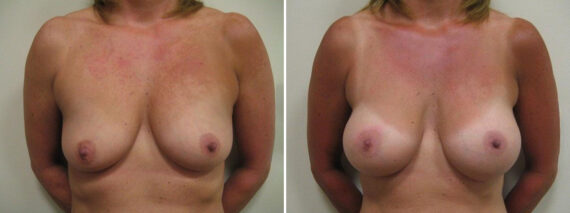 Before and after Breast Augmentation by Dr. David W. Allison, Patient 1515