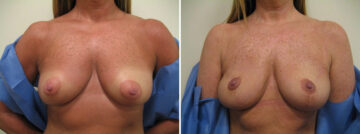 Before and after Breast Augmentation by Dr. David W. Allison, Patient 1519