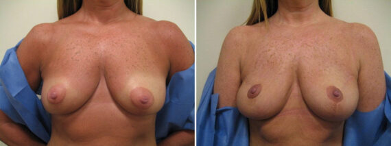 Before and after Breast Augmentation by Dr. David W. Allison, Patient 1519