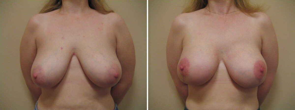 Before and after Breast Augmentation by Dr. David W. Allison, Patient 1523
