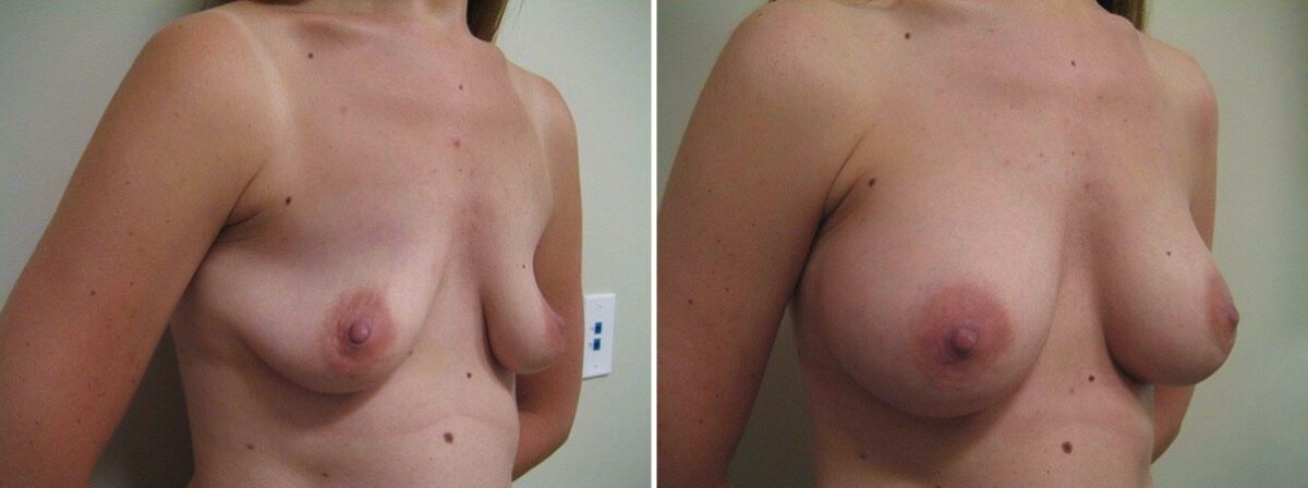 Before and after Breast Augmentation by Dr. David W. Allison, Patient 1527