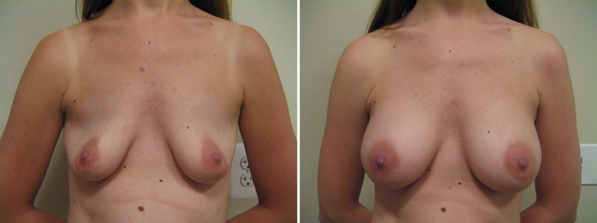 Before and after Breast Augmentation by Dr. David W. Allison, Patient 1527