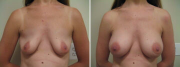 Before and after Breast Augmentation by Dr. David W. Allison, Patient 1527