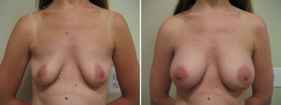 Before and after Breast Augmentation by Dr. David W. Allison, Patient 1527