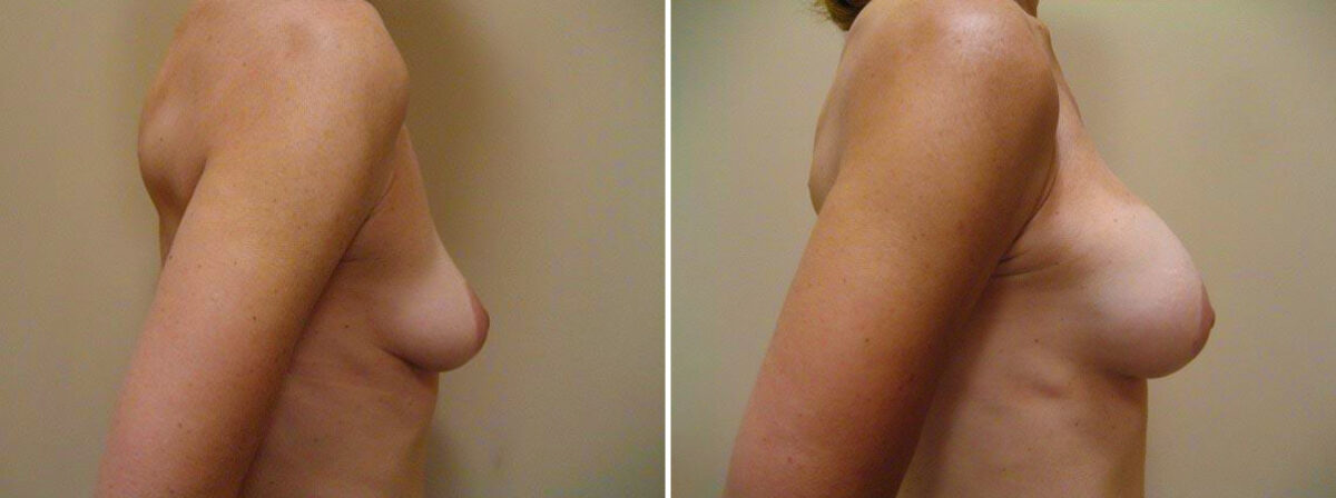 Before and after Breast Augmentation by Dr. David W. Allison, Patient 1534