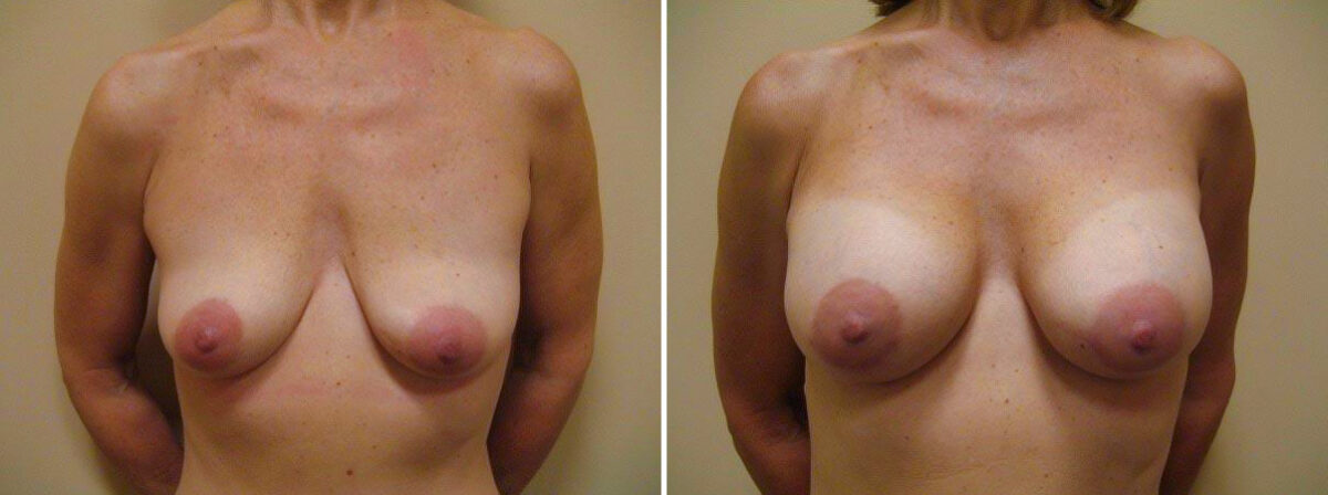 Before and after Breast Augmentation by Dr. David W. Allison, Patient 1534