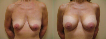 Before and after Breast Augmentation by Dr. David W. Allison, Patient 1534