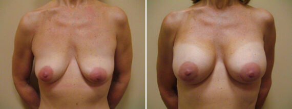 Before and after Breast Augmentation by Dr. David W. Allison, Patient 1534
