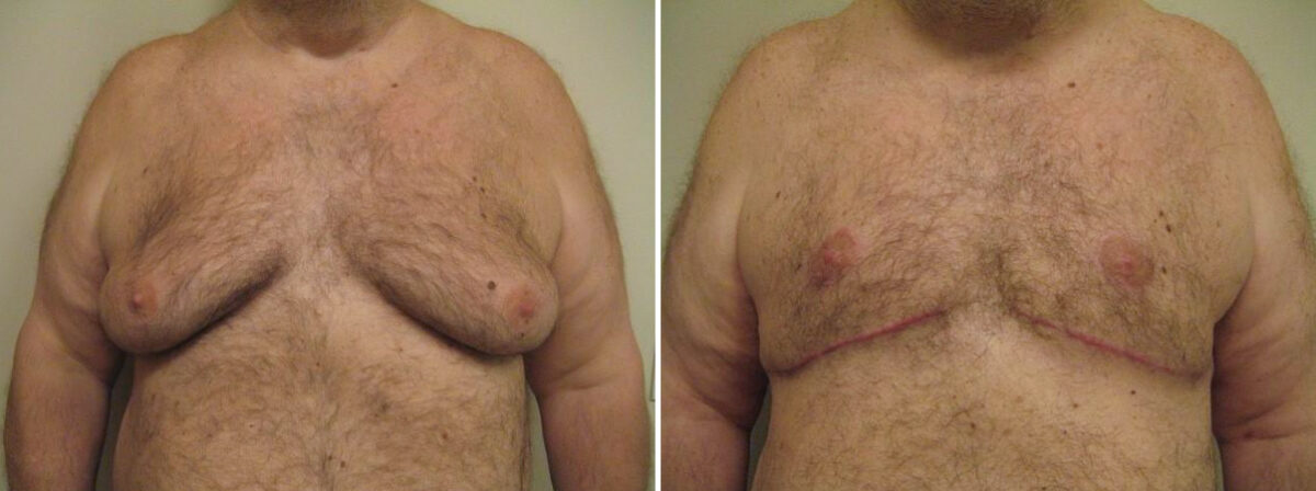 Before and after Gynecomastia Reduction by Dr. David W. Allison, Patient 1541