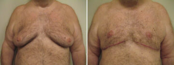 Before and after Gynecomastia Reduction by Dr. David W. Allison, Patient 1541