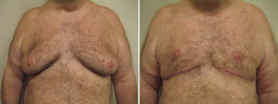 Before and after Gynecomastia Reduction by Dr. David W. Allison, Patient 1541