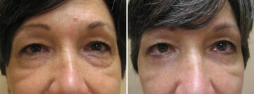Before and after Blepharoplasty by Dr. David W. Allison, Patient 1545