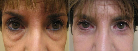 Before and after Blepharoplasty by Dr. David W. Allison, Patient 1549