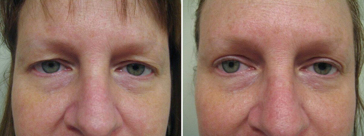 Before and after Blepharoplasty by Dr. David W. Allison, Patient 1553