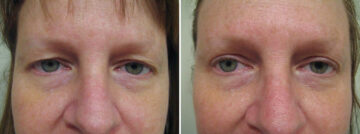 Before and after Blepharoplasty by Dr. David W. Allison, Patient 1553