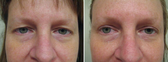 Before and after Blepharoplasty by Dr. David W. Allison, Patient 1553