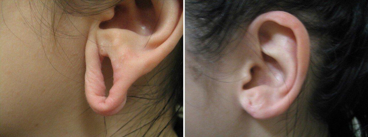 Before and after Ear Gauge Repair by Dr. David W. Allison, Patient 1557